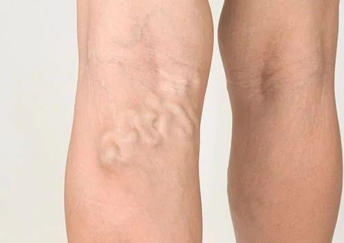 Vein Health Clinic Sydney